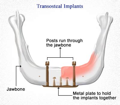 dental implants blog - Dr. Hassan El-Awour's Dental Office