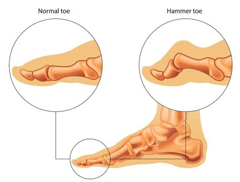 Hammer Toe: A Simple Explanation And Relief Through Exercises - Feel Good Life