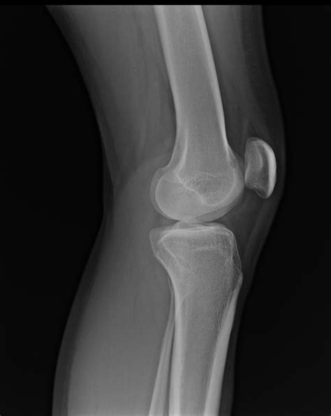 Fibular head fracture | Image | Radiopaedia.org