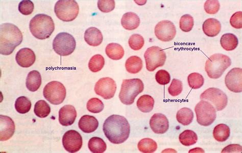 Spherocytosis and hereditary spherocytosis causes, symptoms & treatment