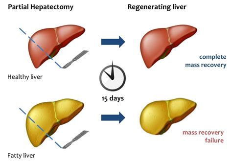 Foie gras and liver regeneration: a fat dilemma