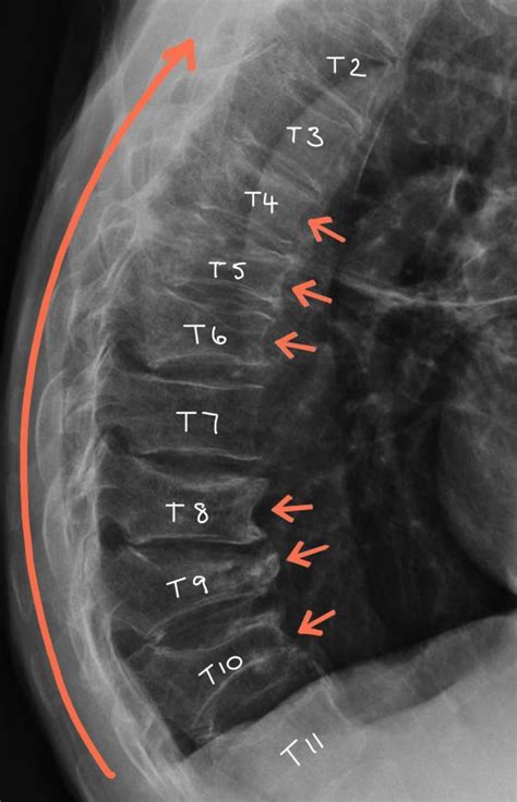 Osteoporotic Vertebral Fractures - Spines Dorset