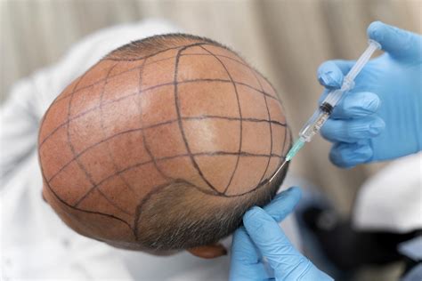 How is the Hair Transplant Recovery Process?