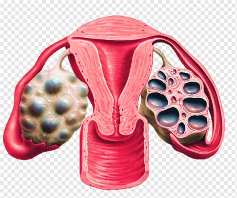 Polycystic ovary syndrome Ovarian cyst Disease, surgical tools, disease, androgen, ovarian Cyst ...