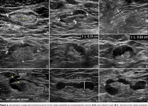 Figure 1 from Axillary ultrasound and fine-needle aspiration in preoperative staging of axillary ...