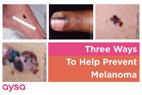 Three Ways You Can Help Prevent Melanoma » Ask Aysa