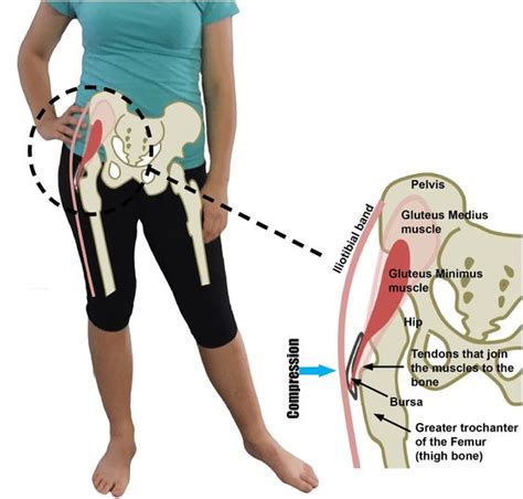 Right Hip Bone Pain Causes You Should Know - DeeahZone | Informasi dan Tips