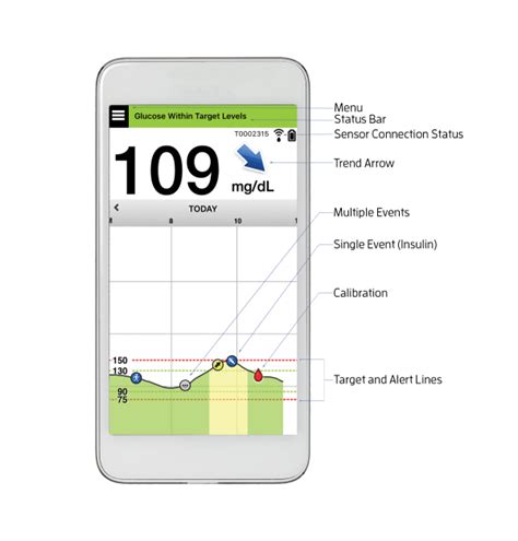 All About the Eversense XL Continuous Glucose Monitor (CGM) – Diabetes Daily