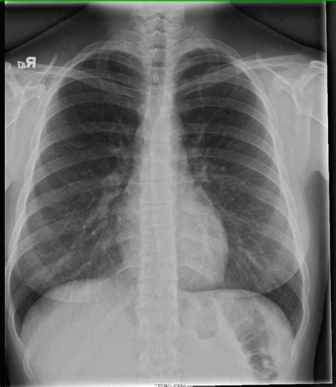 Collection 92+ Images Normal Lung X Ray Pictures Updated