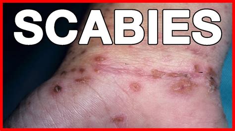 Scabies Signs Symptoms