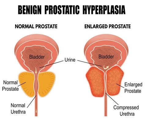 BPH: Symptoms, Complications, and Treatments