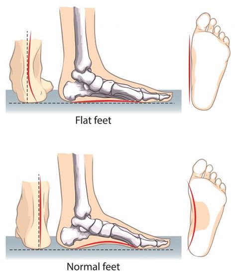 Greater Trochanteric Pain Syndrome (GTPS) - My Family Physio