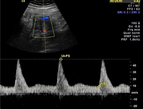 Uterine Artery Doppler of the Gravid Uterus as a Predictor Identifying ...