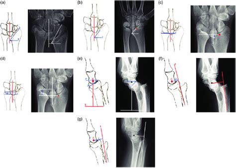 (a) Modified ulnar tilt angle. (b) Modified lunate fossa angle. (c)... | Download Scientific Diagram