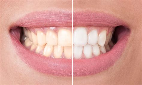 Before and after bleaching - Special Offers Edinburgh | Teeth Whitening ...