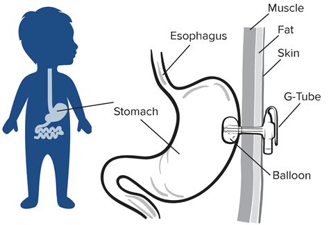 An Introduction To Your Child's Gastrostomy Tube Patient, 45% OFF