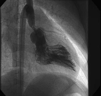 Modified aortoplasty for discrete congenital supravalvular aortic stenosis - The Journal of ...