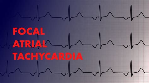 Paroxysmal Atrial Tachycardia Vs Sinus Tachycardia