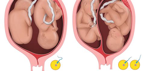 What are Dichorionic Diamniotic twins? Are there risks involved in ...