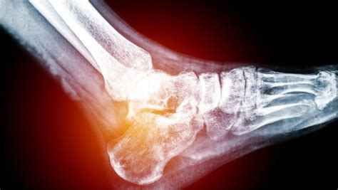 Gout in Heel: Causes, Signs and Treatment