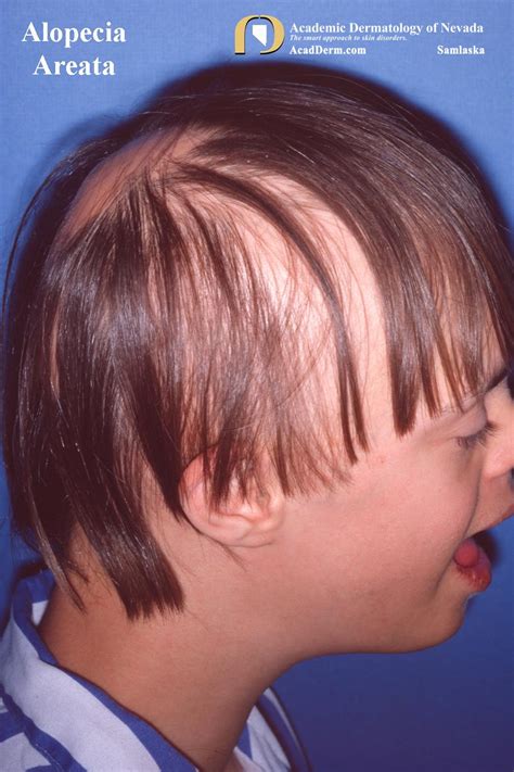 Alopecia Areata: Autoimmune Alopecia... - Academic Dermatology of Nevada