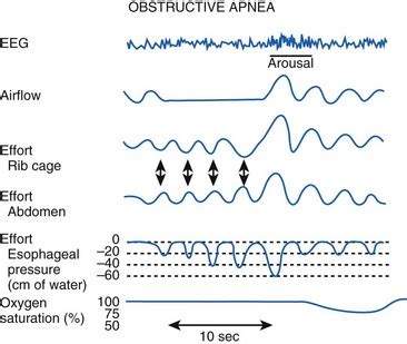 Obesity, Sleep Apnea, the Airway, and Anesthesia | Anesthesia Key