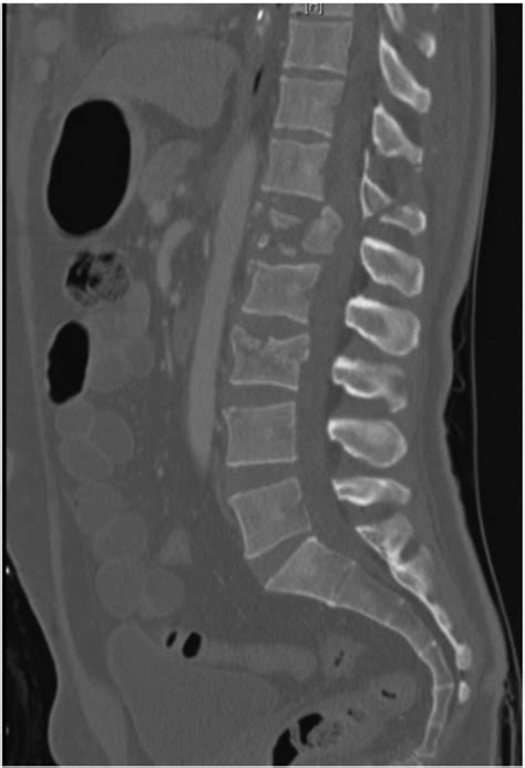 Ct Scan Lumbar Spine