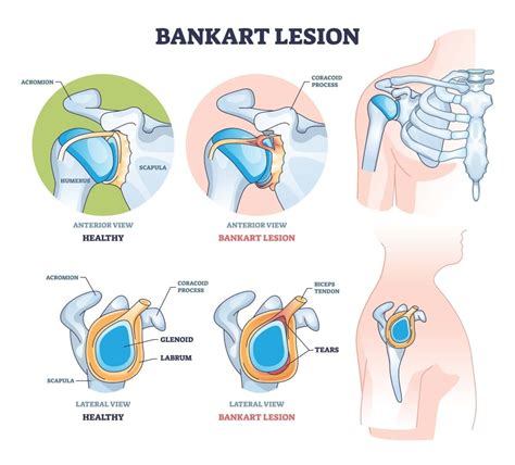 Bankart Lesion | Symptoms, Causes and Exercises