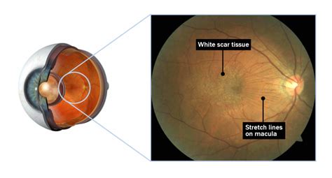 Epiretinal Membranes – Eye Doctors Mona Vale