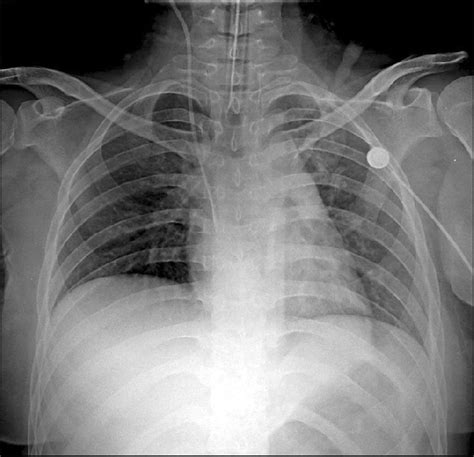 Initial chest X-ray revealed interstitial pulmonary edema. | Download Scientific Diagram