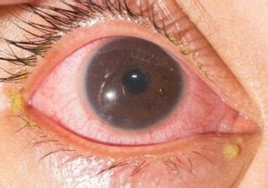 👉 What is iridocyclitis - Causes, Symptoms, Types, Treatment (February 2022)