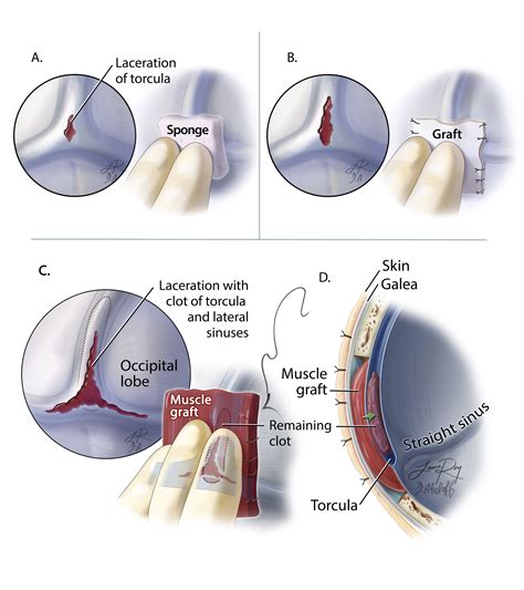 Dural Venous Sinus Injury | The Neurosurgical Atlas, by Aaron Cohen ...