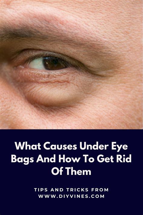 What Causes Under Eye Bags And How To Get Rid Of Them | Eye bags, Under ...