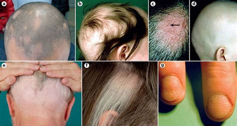 Alopecia areata causes, symptoms and best treatment for alopecia areata