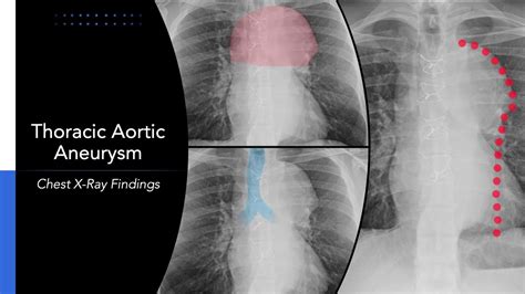 Thoracic Aortic Aneurysm Chest X Ray | My XXX Hot Girl