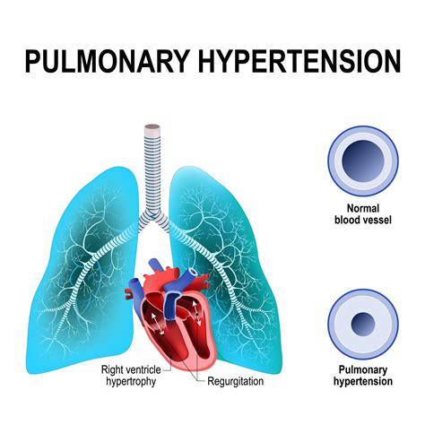 5 Types of Pulmonary Hypertension