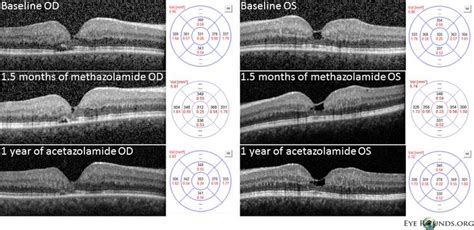 Idiopathic Juxtafoveal Telangiectasia Type II (Macular Telangiectasia type 2) | Eyes, 5 months ...