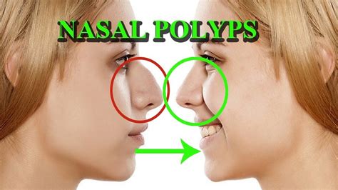 Nasal Polyps - Signs, Symptoms, Causes and Treatment | Arogyam Allergy