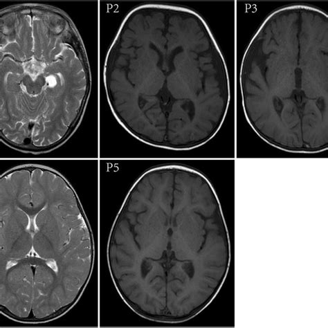 Brain MRI scans showed slight changes: choroid plexus cysts in the... | Download Scientific Diagram