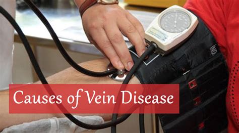 Causes of Vein Disease - Dot Com Women