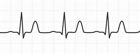 Hyperkalaemia on ECG | ECG Disease Patterns - MedSchool