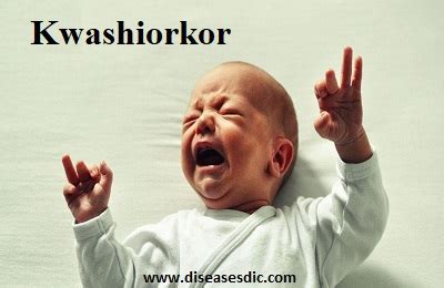 Kwashiorkor – Causes, Symptoms, and Diagnosis.