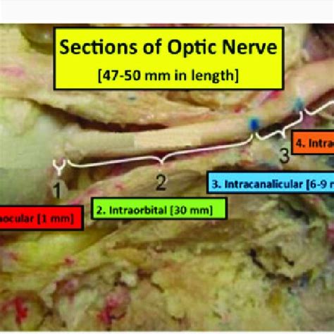 Optic Nerve Anatomy. The Optic Nerve is 47-50 mm in length extending ...