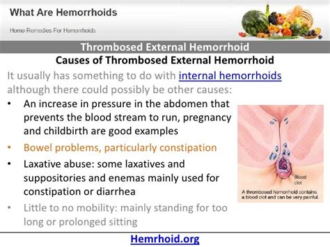 Thrombosed External Hemorrhoid