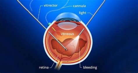 Diabetic Retinopathy (DR): Symptoms and Treatment - Neoretina Blog