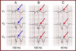 Epsilon Wave in the 12-Lead Electrocardiogram: Is Its Frequency ...