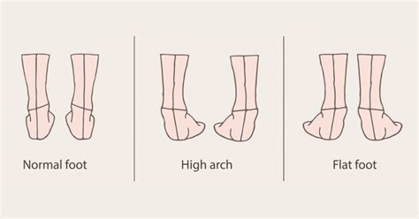 9 High Arch Foot Exercises - PostureInfoHub