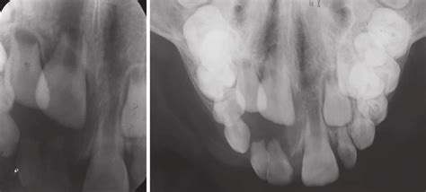 Intraoral periapical and occlusal radiograph | Download Scientific Diagram