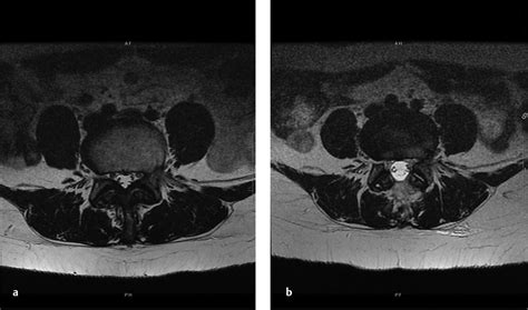 Minimally Invasive Lumbar Laminectomy | Neupsy Key