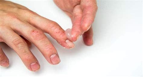 Side effects of topical steroids you should know about! | TheHealthSite.com